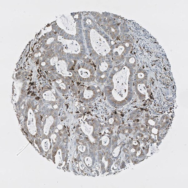 IHC of tissue microarray core of colon cancer stained with DSHB antibody CPTC-CD74-1 against CD74 (brown). Image credit: Clinical Proteomics Technologies for Cancer